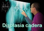 Displasia de cadera