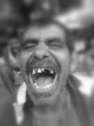 Persona con gingivitis