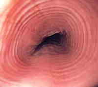 Intestino con enfermedad inflamatoria