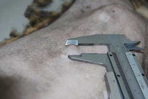 Tumor mamario de 1cm de diámetro.