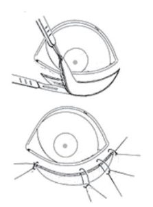 Esquema de una cirugía de entropion