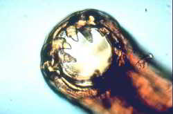 anquilostoma