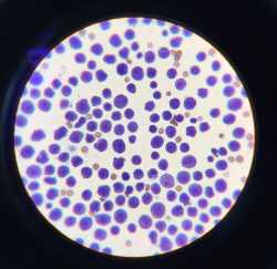 Liquido pleural gato con linfoma